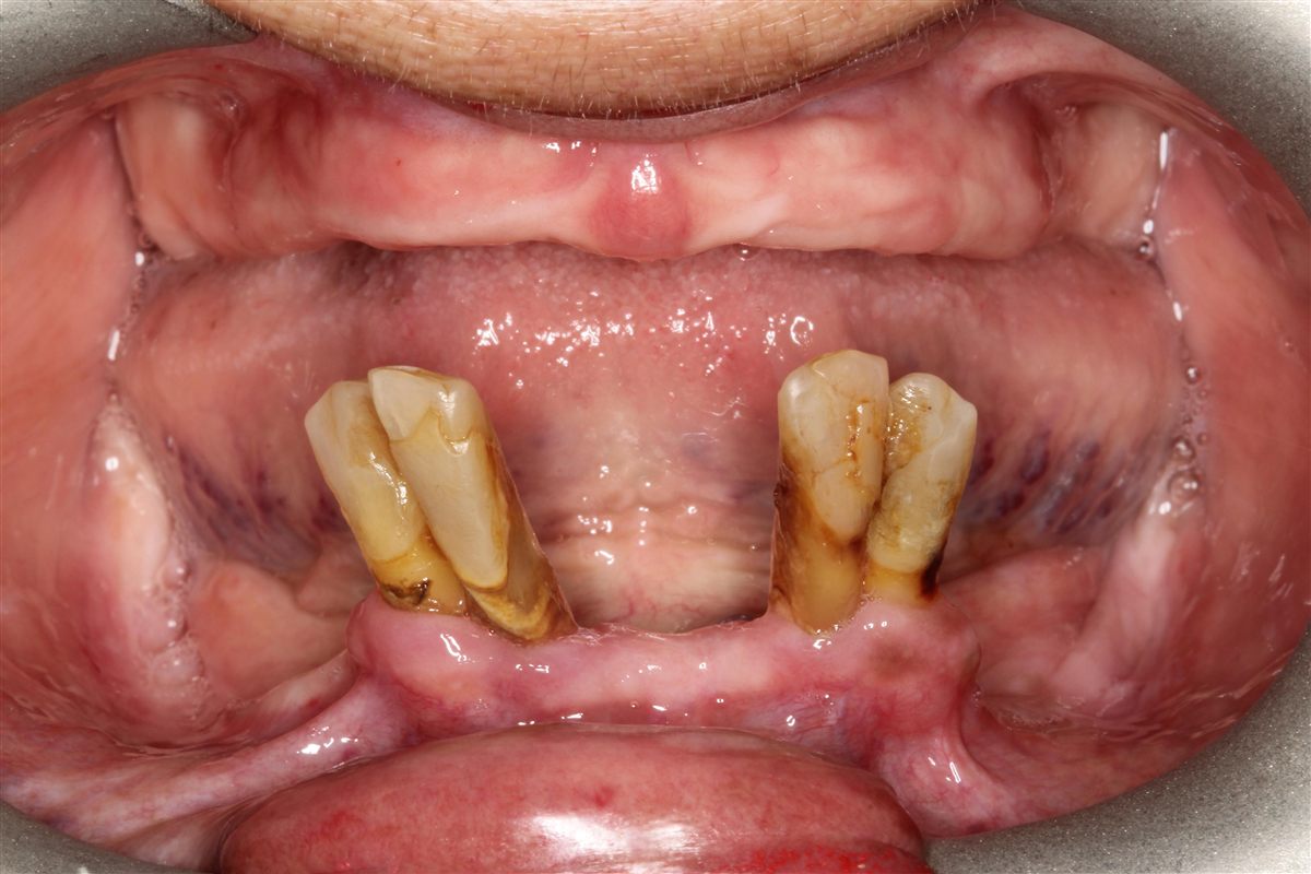 Boca de paciente con desgaste y pérdida dental severa